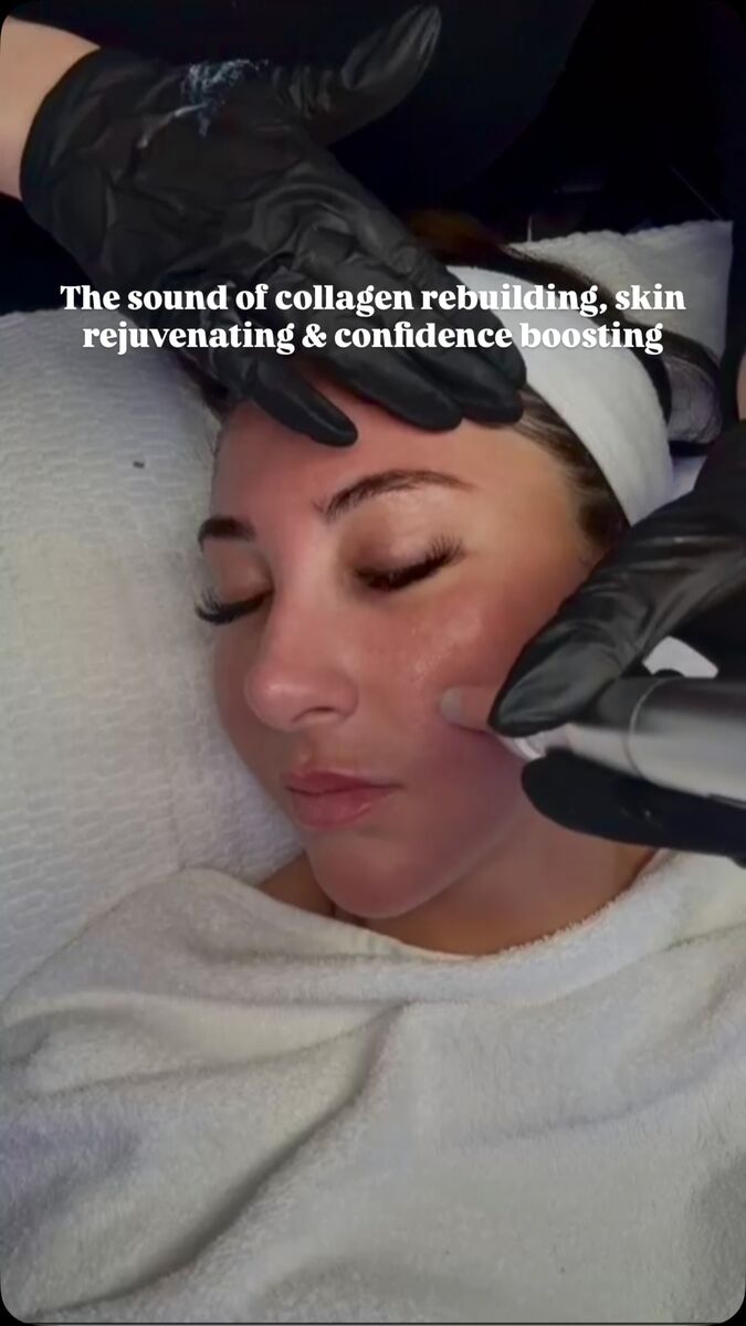 Microneedling treatment on the Wirral — collagen rebuilding