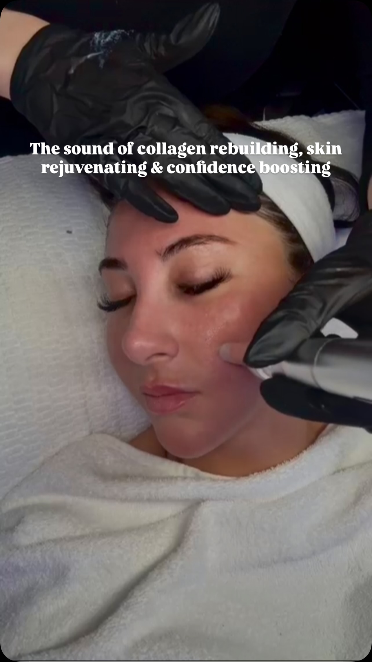 Microneedling treatment — collagen rebuilding