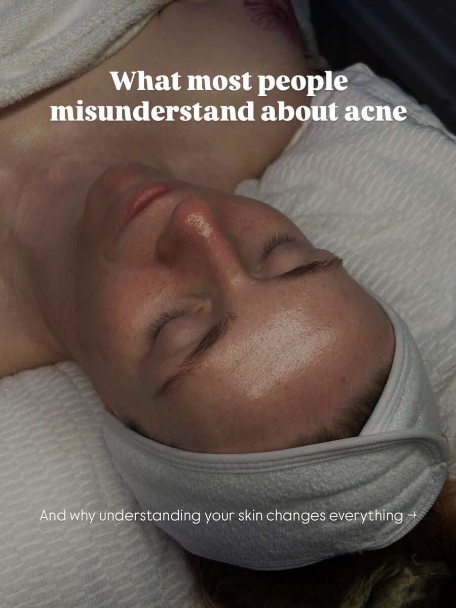 Skin and acne education — understanding your skin